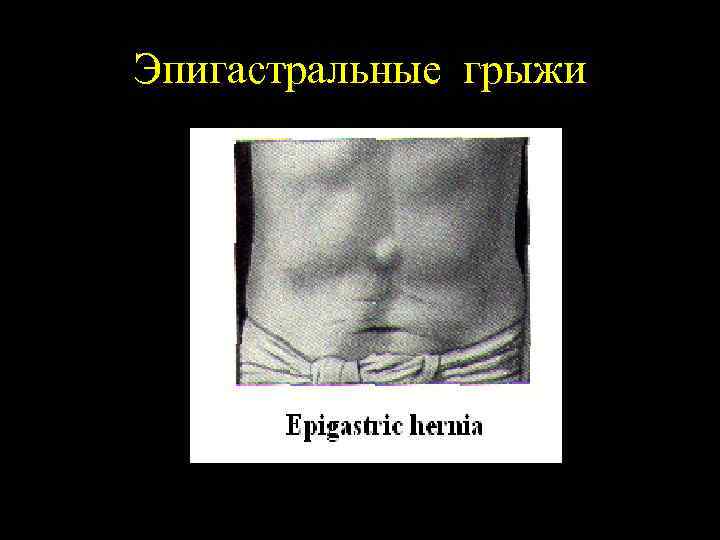 Эпигастральные грыжи 