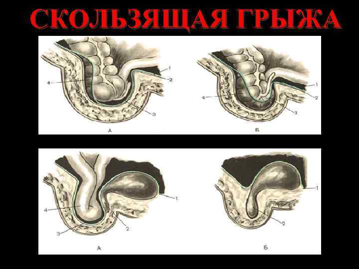 СКОЛЬЗЯЩАЯ ГРЫЖА 