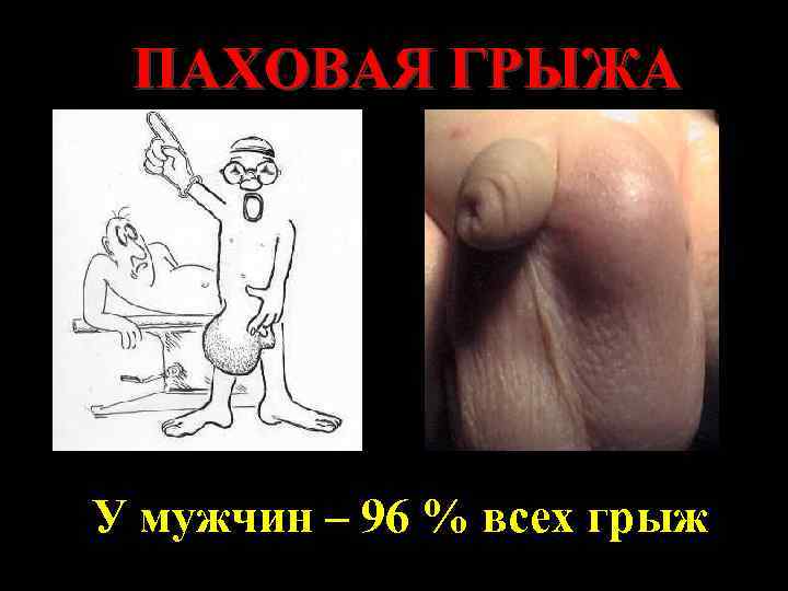 ПАХОВАЯ ГРЫЖА У мужчин – 96 % всех грыж 