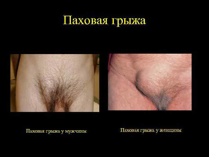 Паховая грыжа у мужчины Паховая грыжа у женщины 