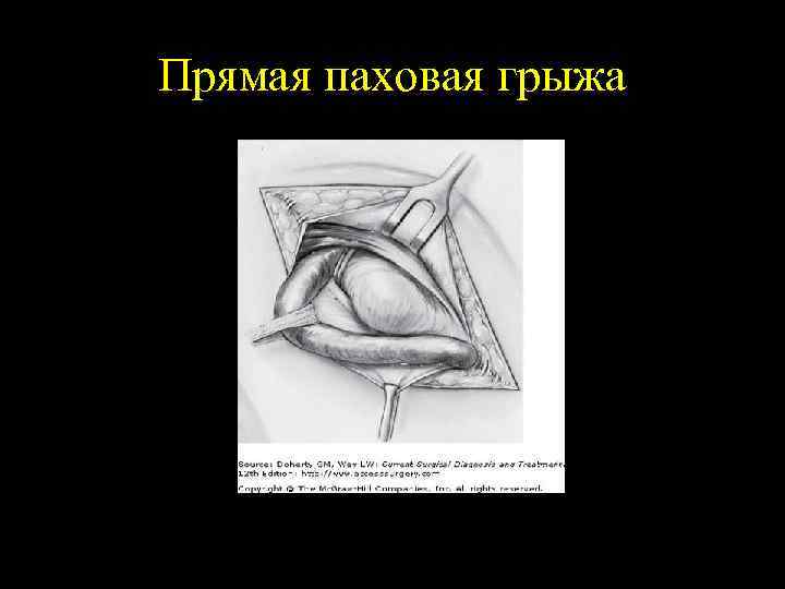 Прямая паховая грыжа 