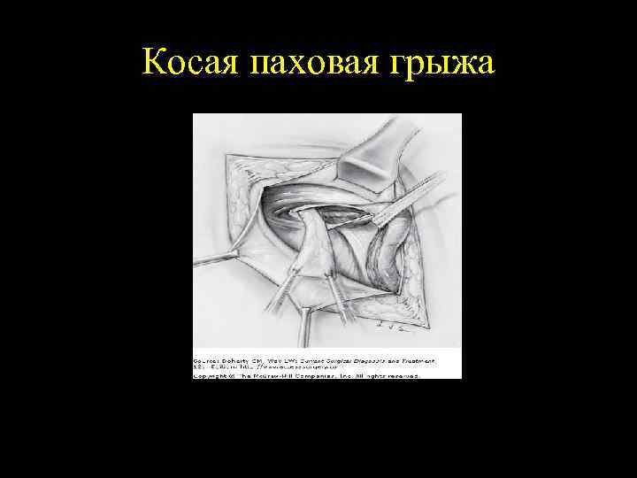 Косая паховая грыжа 