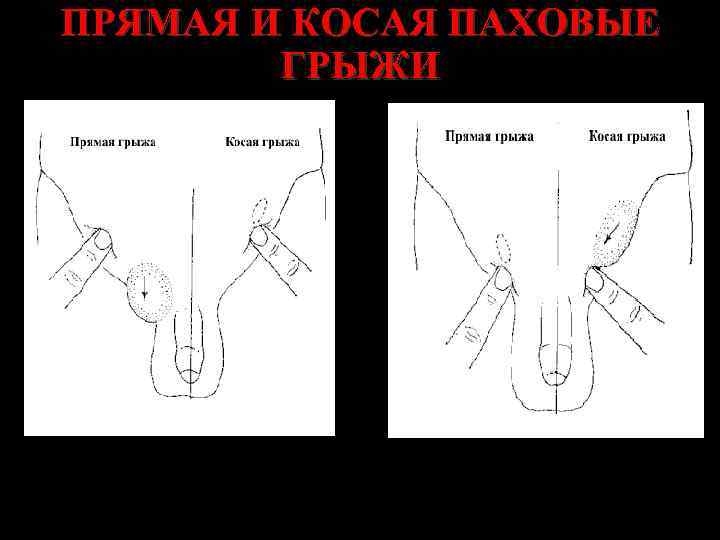 ПРЯМАЯ И КОСАЯ ПАХОВЫЕ ГРЫЖИ 