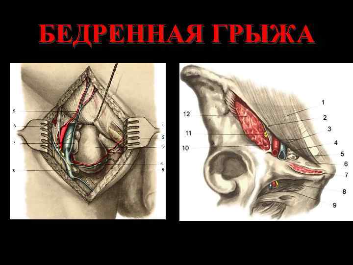 БЕДРЕННАЯ ГРЫЖА 