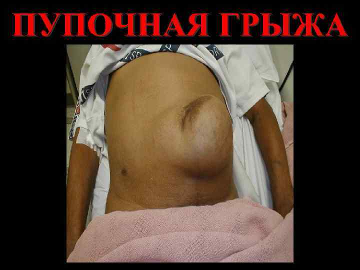 ПУПОЧНАЯ ГРЫЖА 