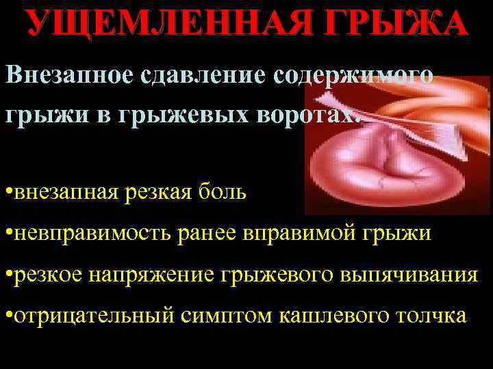 УЩЕМЛЕННАЯ ГРЫЖА Внезапное сдавление содержимого грыжи в грыжевых воротах. • внезапная резкая боль •