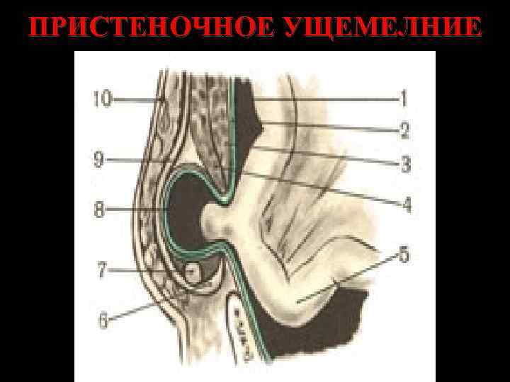 ПРИСТЕНОЧНОЕ УЩЕМЕЛНИЕ 