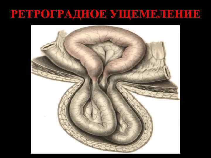 РЕТРОГРАДНОЕ УЩЕМЕЛЕНИЕ 