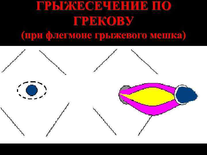 ГРЫЖЕСЕЧЕНИЕ ПО ГРЕКОВУ (при флегмоне грыжевого мешка) 