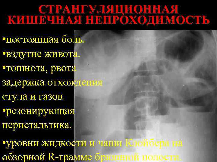 СТРАНГУЛЯЦИОННАЯ КИШЕЧНАЯ НЕПРОХОДИМОСТЬ • постоянная боль. • вздутие живота. • тошнота, рвота задержка отхождения