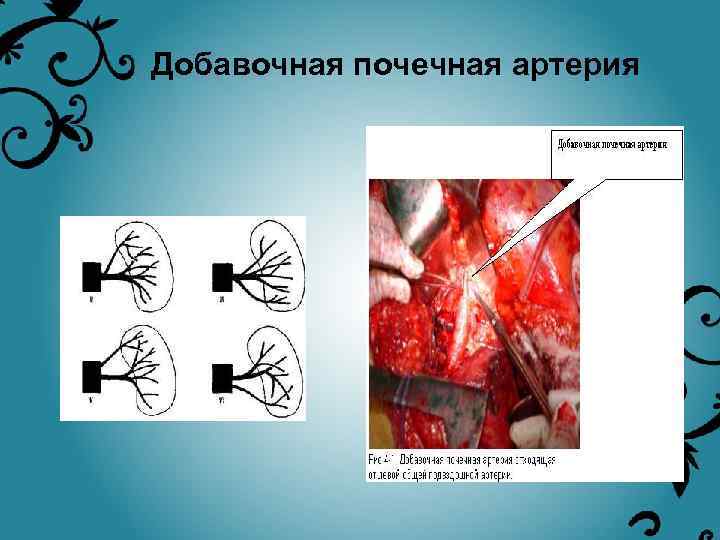 Добавочная почечная артерия • 