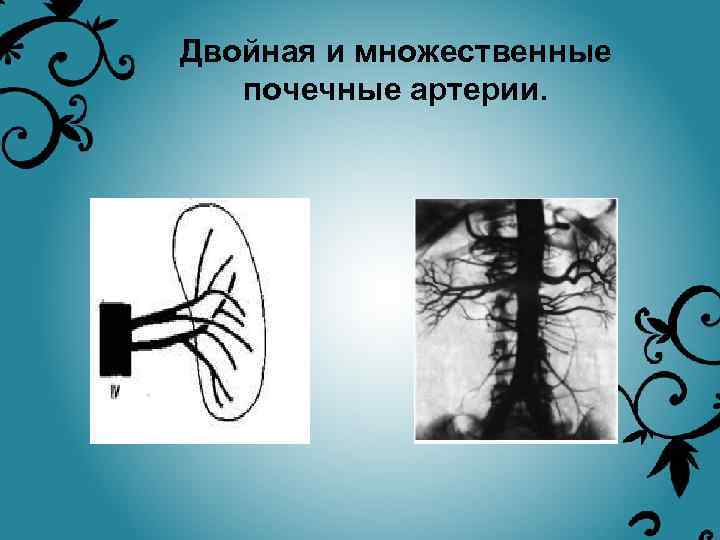 Двойная и множественные почечные артерии. 