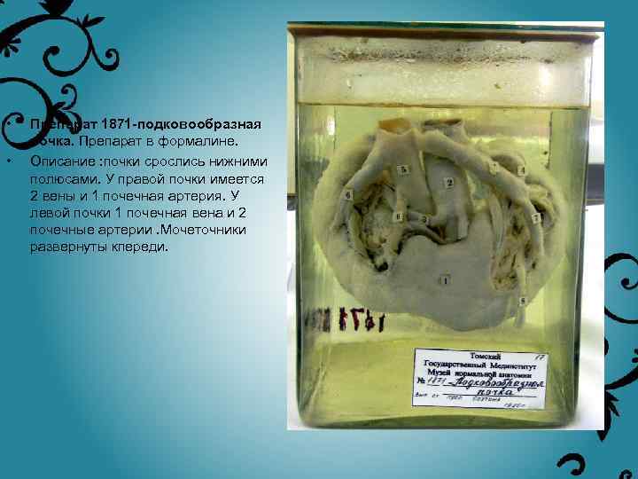  • • Препарат 1871 -подковообразная почка. Препарат в формалине. Описание : почки срослись