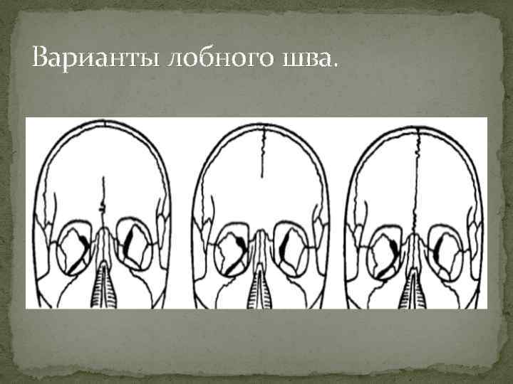 Швы лобной кости