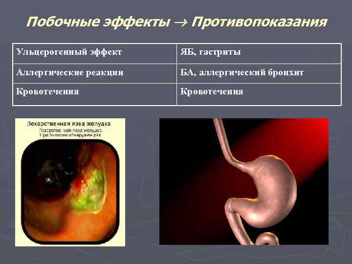 Побочные эффекты Противопоказания Ульцерогенный эффект ЯБ, гастриты Аллергические реакции БА, аллергический бронхит Кровотечения 