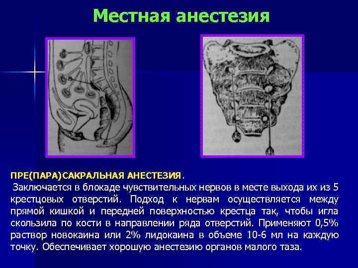 Местная анестезия ПРЕ(ПАРА)САКРАЛЬНАЯ АНЕСТЕЗИЯ. Заключается в блокаде чувствительных нервов в месте выхода их из