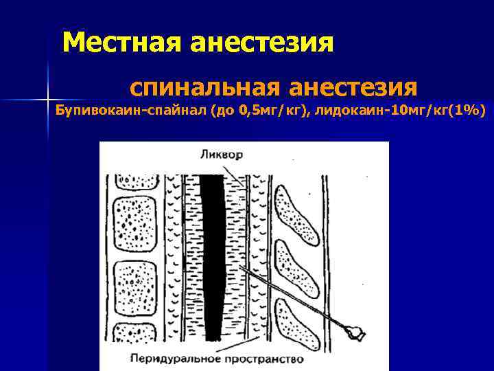 Местная анестезия спинальная анестезия Бупивокаин спайнал (до 0, 5 мг/кг), лидокаин 10 мг/кг(1%) 