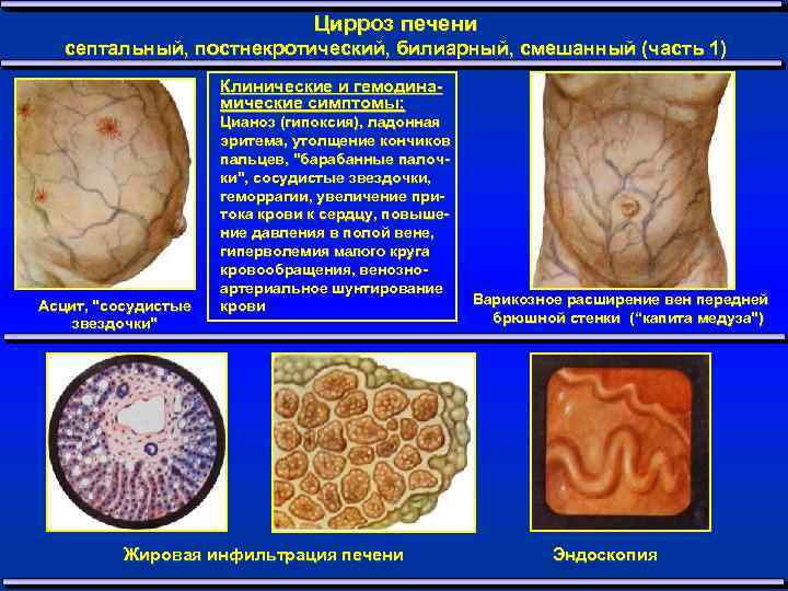 Цирроз печени септальный, постнекротический, билиарный, смешанный (часть 1) Клинические и гемодинамические симптомы: Асцит, "сосудистые