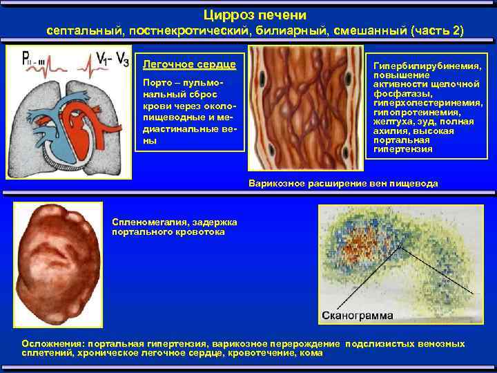 Цирроз печени септальный, постнекротический, билиарный, смешанный (часть 2) Легочное сердце Порто – пульмональный сброс