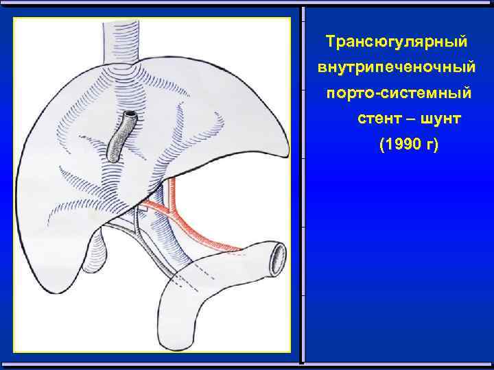 Трансюгулярный внутрипеченочный порто-системный стент – шунт (1990 г) 