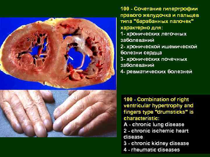 100 - Сочетание гипертрофии правого желудочка и пальцев типа "барабанных палочек" характерно для: 1