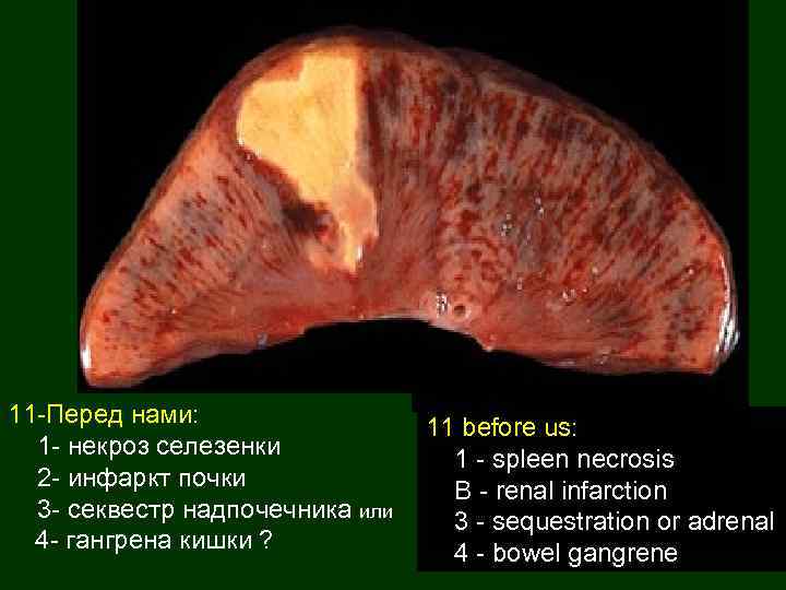 11 -Перед нами: 1 - некроз селезенки 2 - инфаркт почки 3 - секвестр