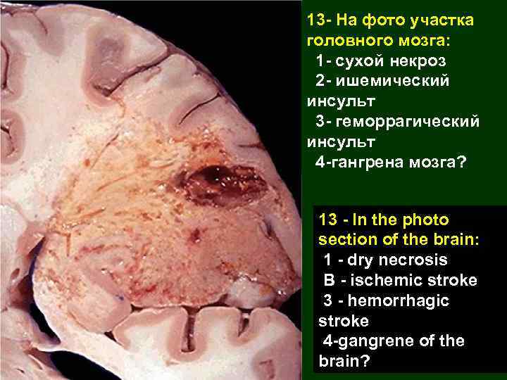 13 - На фото участка головного мозга: 1 - сухой некроз 2 - ишемический