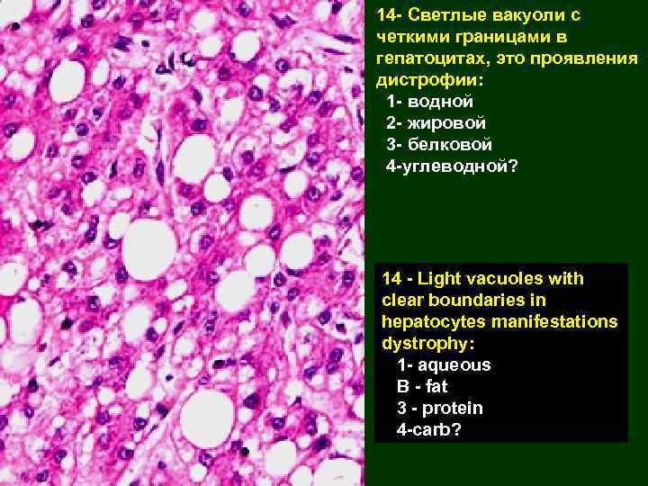 14 - Светлые вакуоли с четкими границами в гепатоцитах, это проявления дистрофии: 1 -