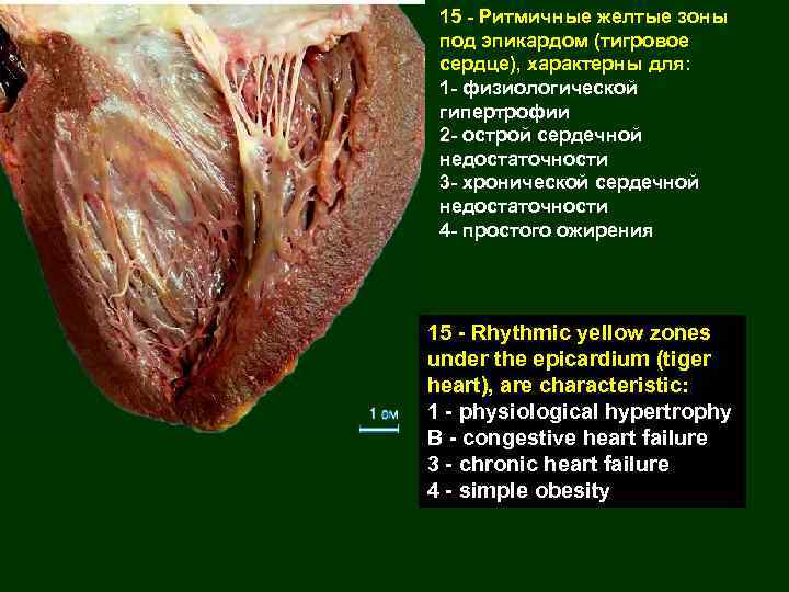 15 - Ритмичные желтые зоны под эпикардом (тигровое сердце), характерны для: 1 - физиологической