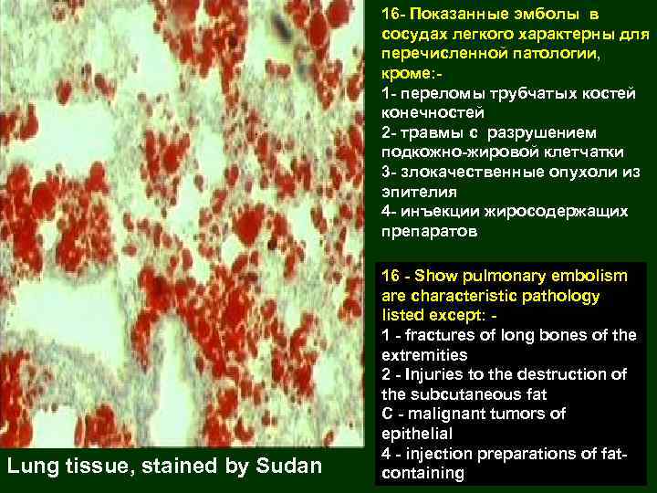 16 - Показанные эмболы в сосудах легкого характерны для перечисленной патологии, кроме: - 1