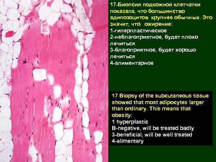 17 -Биопсия подкожной клетчатки показала, что большинство адипозоцитов крупнее обычных. Это значит, что ожирение: