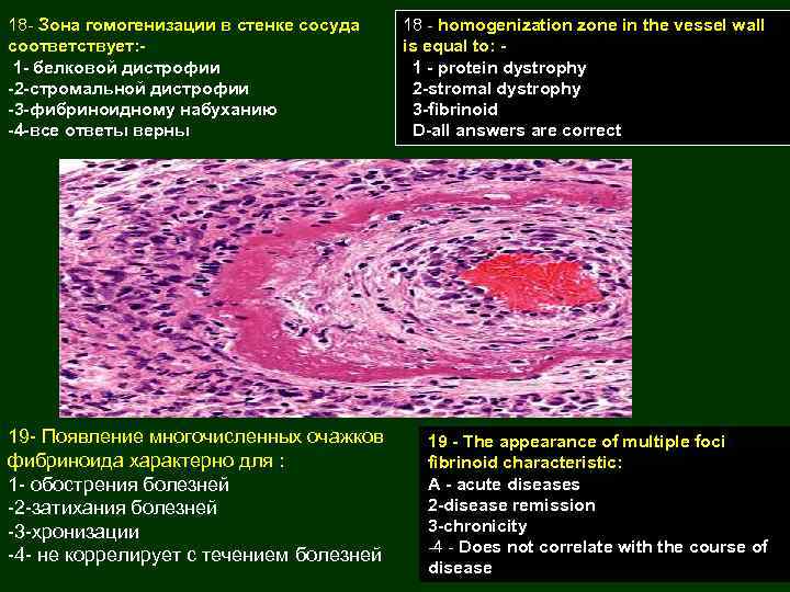 18 - Зона гомогенизации в стенке сосуда соответствует: 1 - белковой дистрофии -2 -стромальной
