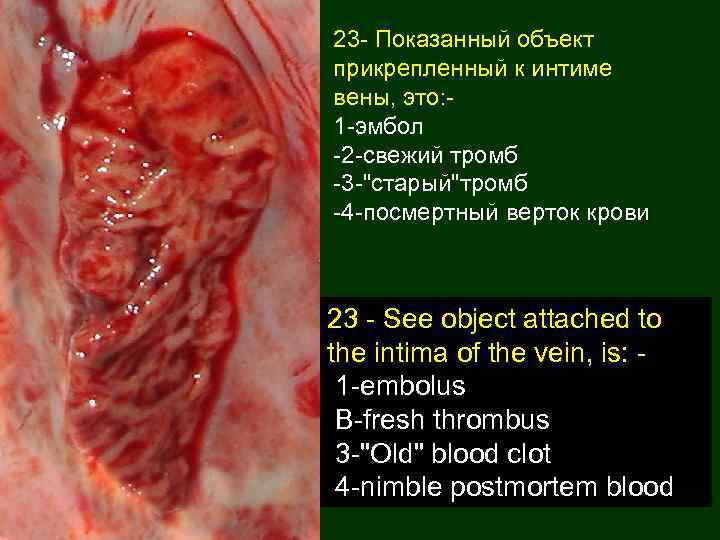23 - Показанный объект прикрепленный к интиме вены, это: 1 -эмбол -2 -свежий тромб