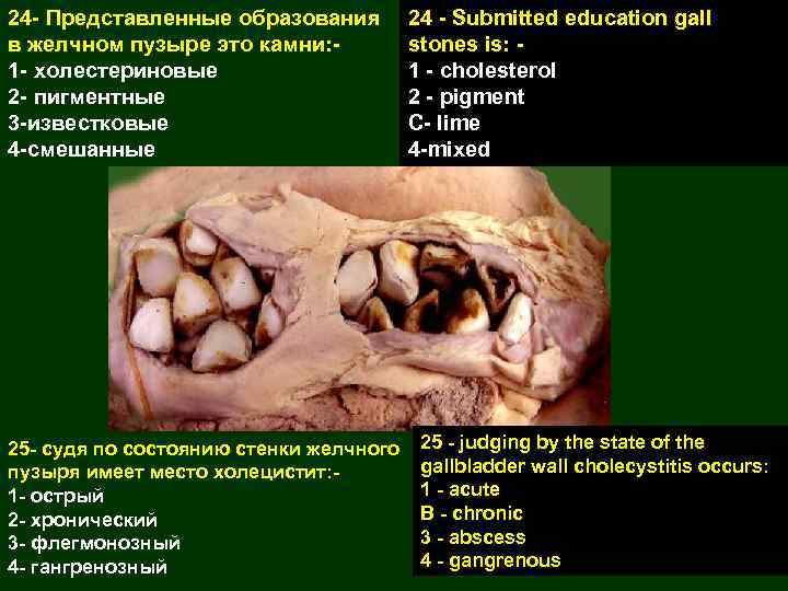 24 - Представленные образования в желчном пузыре это камни: 1 - холестериновые 2 -
