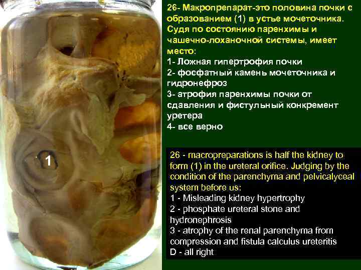 26 - Макропрепарат-это половина почки с образованием (1) в устье мочеточника. Судя по состоянию