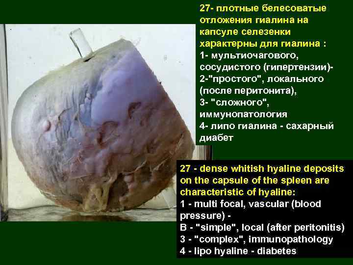 27 - плотные белесоватые отложения гиалина на капсуле селезенки характерны для гиалина : 1
