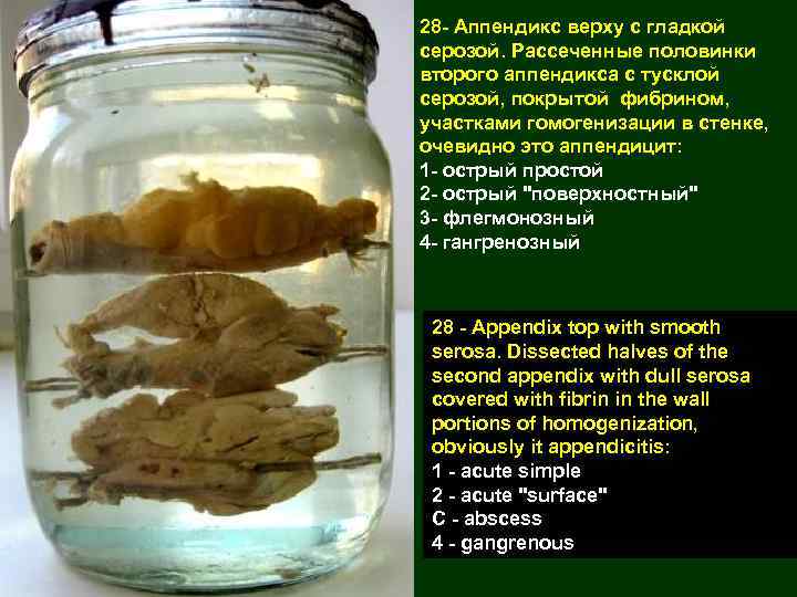 28 - Аппендикс верху с гладкой серозой. Рассеченные половинки второго аппендикса с тусклой серозой,