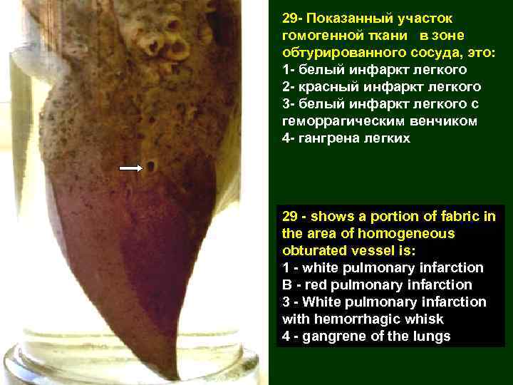 29 - Показанный участок гомогенной ткани в зоне обтурированного сосуда, это: 1 - белый