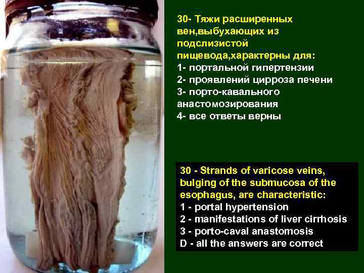 30 - Тяжи расширенных вен, выбухающих из подслизистой пищевода, характерны для: 1 - портальной