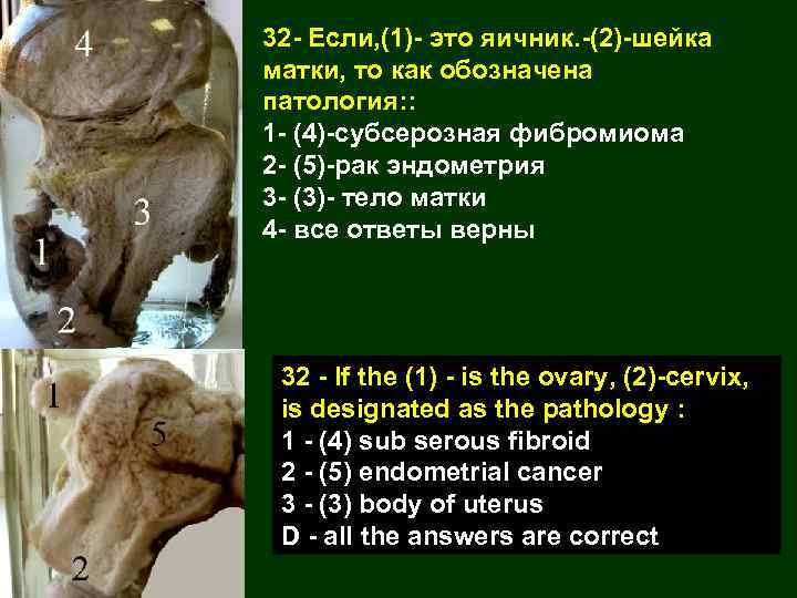 32 - Если, (1)- это яичник. -(2)-шейка матки, то как обозначена патология: : 1