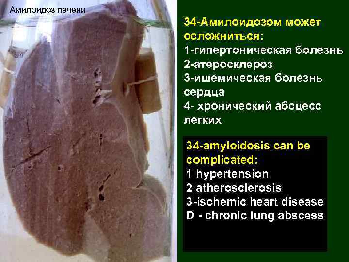 Амилоидоз печени 34 -Амилоидозом может осложниться: 1 -гипертоническая болезнь 2 -атеросклероз 3 -ишемическая болезнь