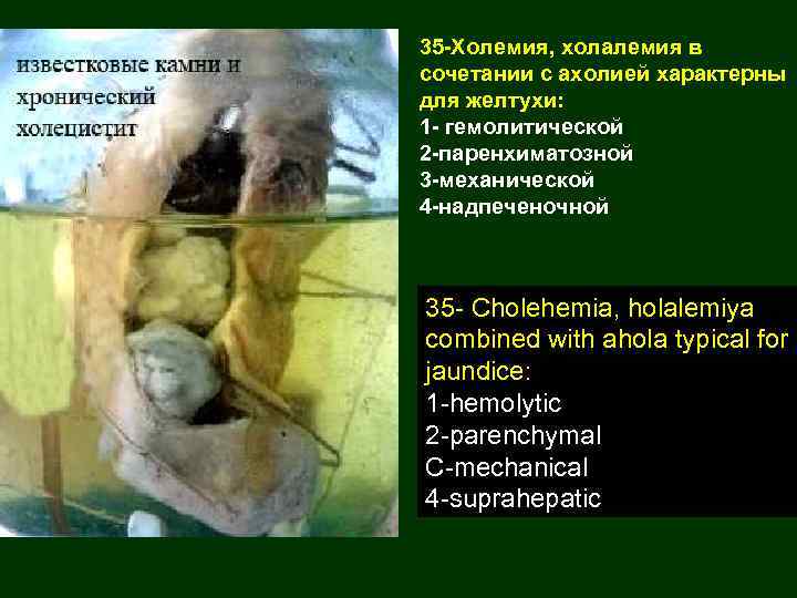 35 -Холемия, холалемия в сочетании с ахолией характерны для желтухи: 1 - гемолитической 2