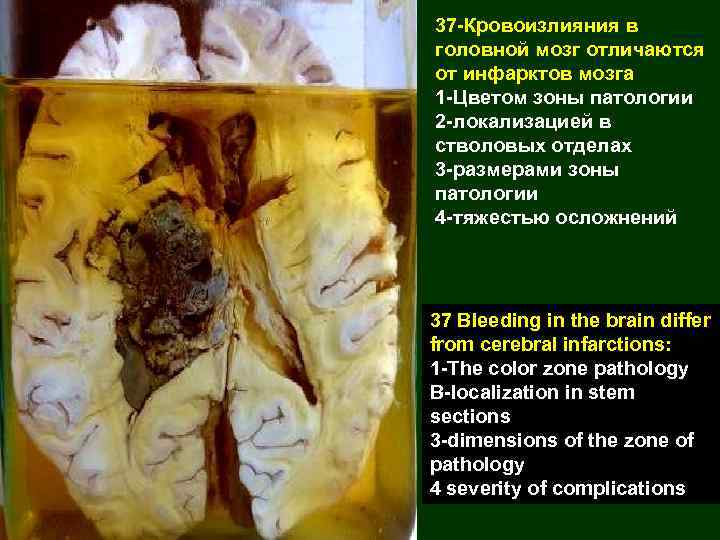37 -Кровоизлияния в головной мозг отличаются от инфарктов мозга 1 -Цветом зоны патологии 2
