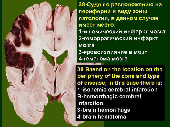 38 -Судя по расположению на периферии и виду зоны патологии, в данном случае имеет