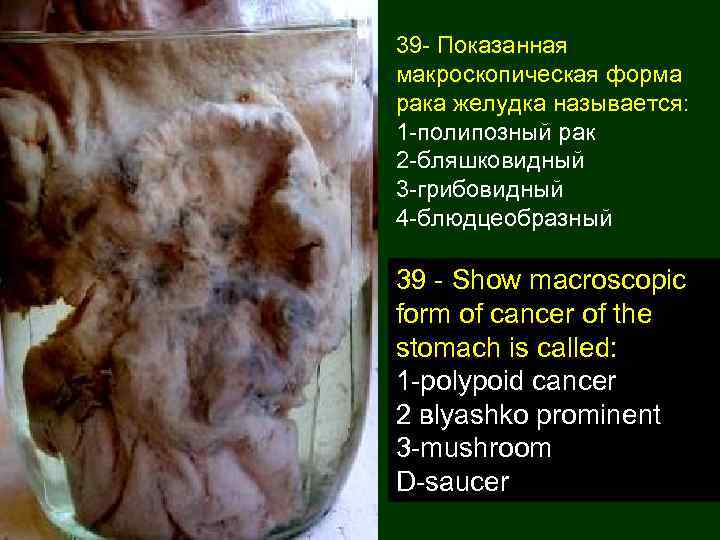 39 - Показанная макроскопическая форма рака желудка называется: 1 -полипозный рак 2 -бляшковидный 3