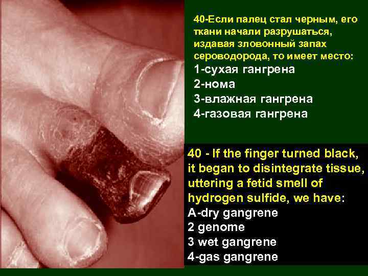 40 -Если палец стал черным, его ткани начали разрушаться, издавая зловонный запах сероводорода, то