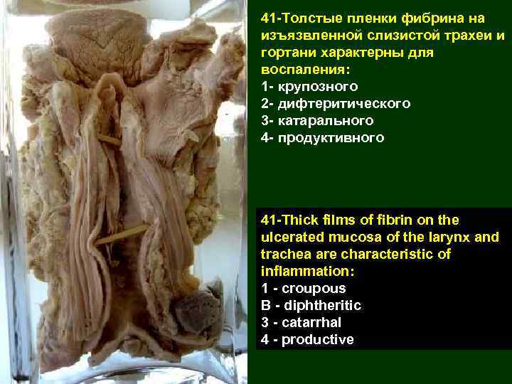 41 -Толстые пленки фибрина на изъязвленной слизистой трахеи и гортани характерны для воспаления: 1