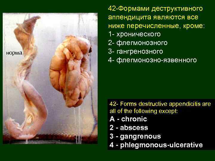 норма 42 -Формами деструктивного аппендицита являются все ниже перечисленные, кроме: 1 - хронического 2