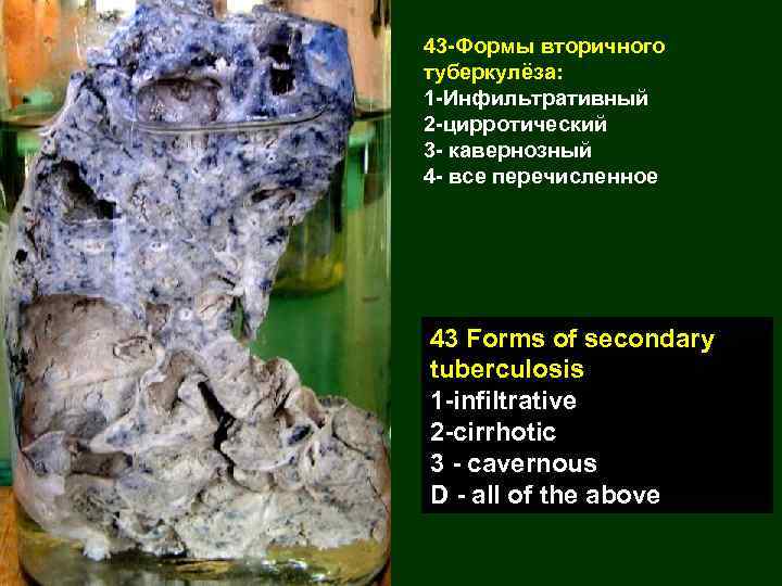 43 -Формы вторичного туберкулёза: 1 -Инфильтративный 2 -цирротический 3 - кавернозный 4 - все