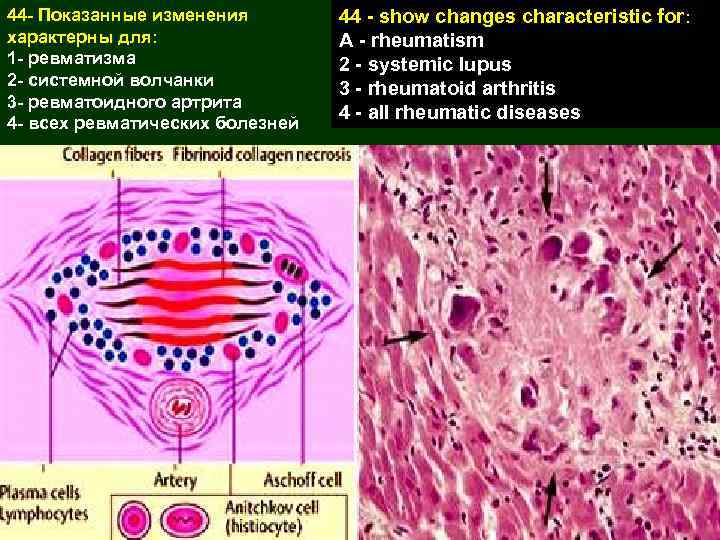 44 - Показанные изменения характерны для: 1 - ревматизма 2 - системной волчанки 3